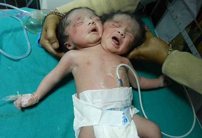 Two headed ‘Miracle’ baby girl born in Bangladesh